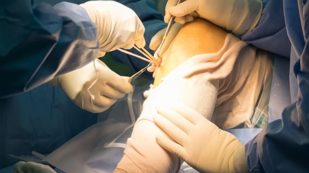 ACL Reconstruction by Dr. Manish Saini in Surat