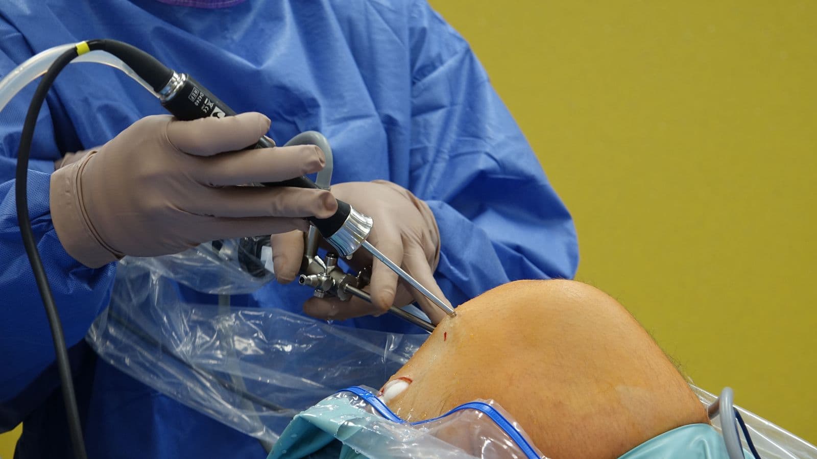 Arthroscopy at the clinic of Dr. Manish Saini, Surat