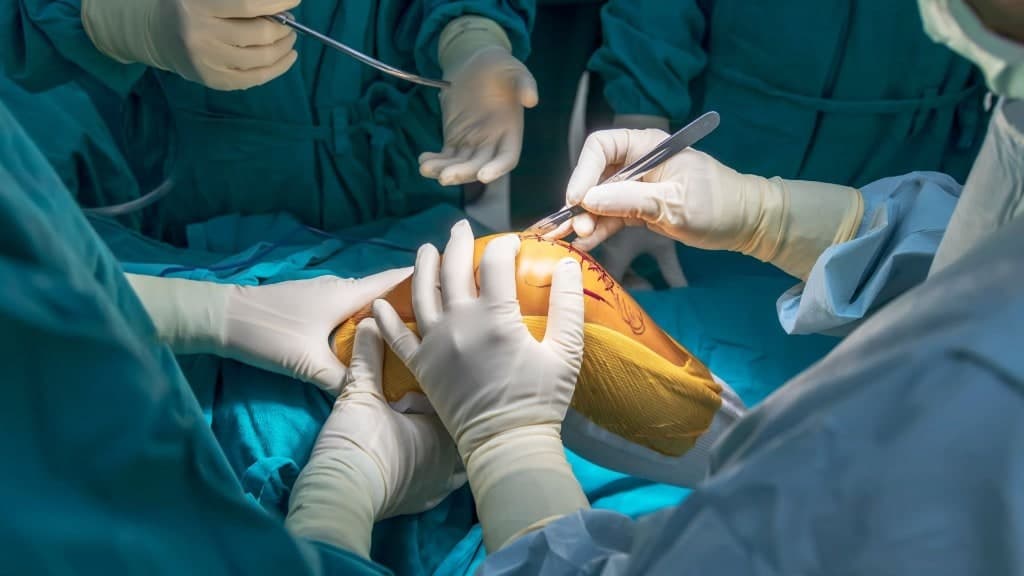 Knee Replacement by Dr. Manish Saini in Surat